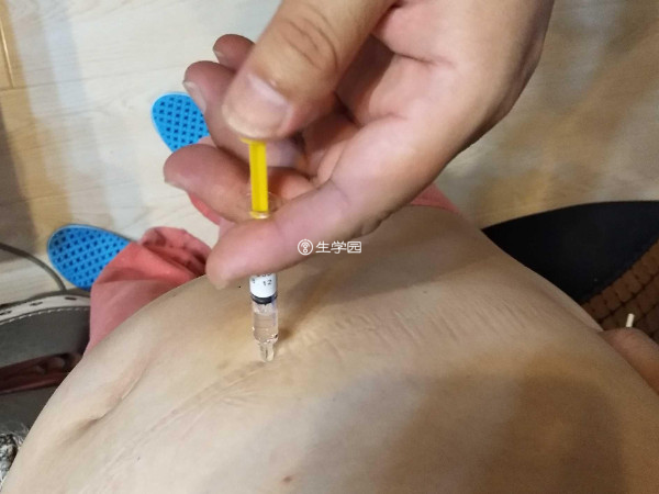 试管降调针注射方法图解