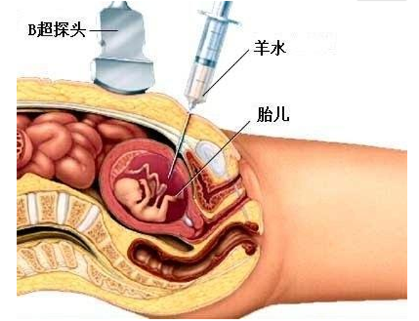 羊水穿刺检查流程