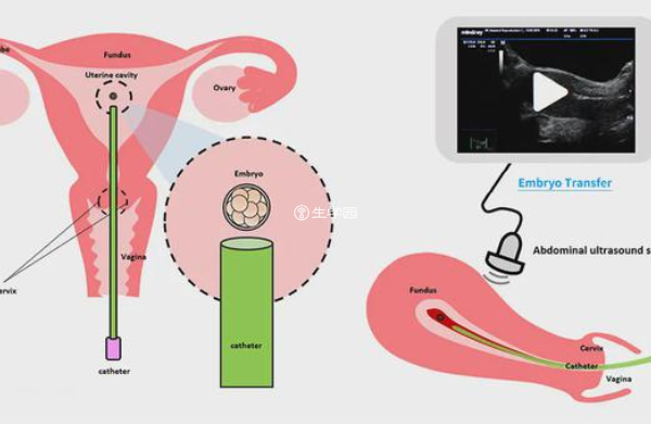 通过阴超移植胚胎就可以不憋尿