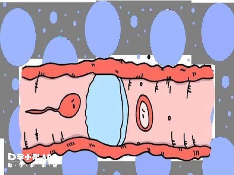 已经堵塞的输卵管