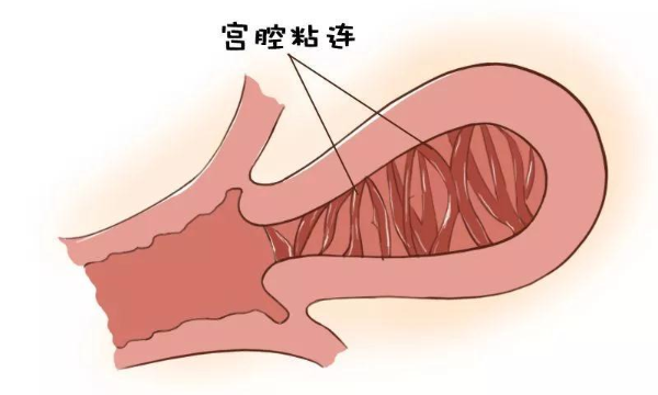 宫腔粘连妊娠有关