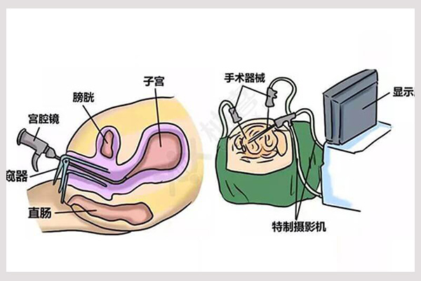 宫腔镜手术