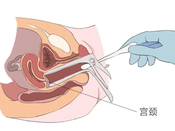 宫腔粘连严重会威胁生命