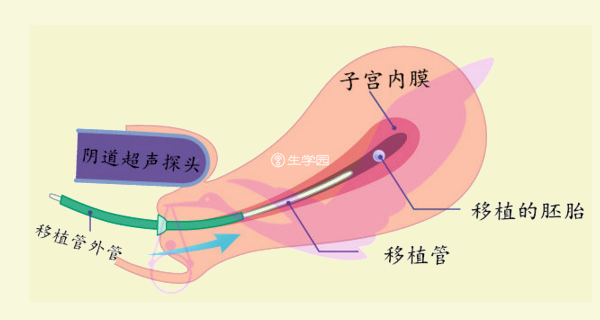 没有憋尿是不利B超观察移植胚胎的