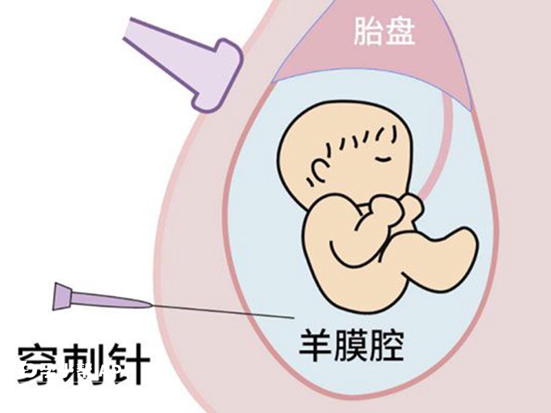 羊穿是确认胎儿患病的重要手段