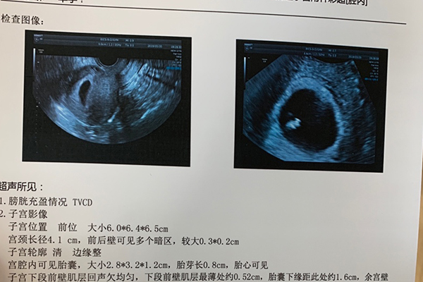 胎芽长和宽相差一倍以上怀男孩