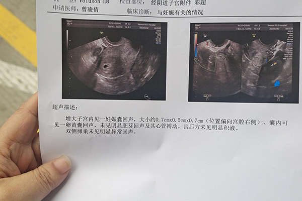 孕6周查出胎心胎芽不能判断胎儿性别