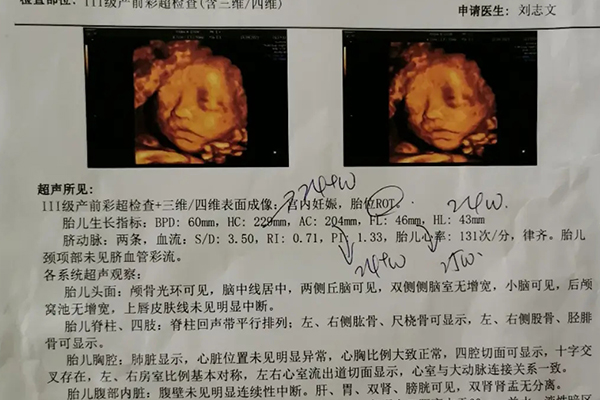 四维超声检查单