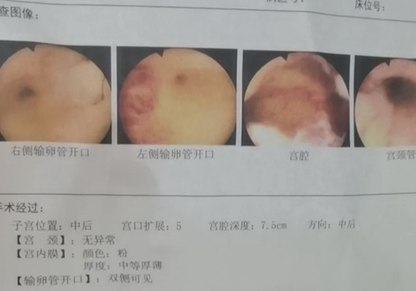 有不孕情况时就可查宫腔镜