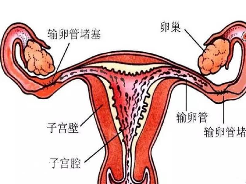 输卵管堵塞可以选择手术疏通