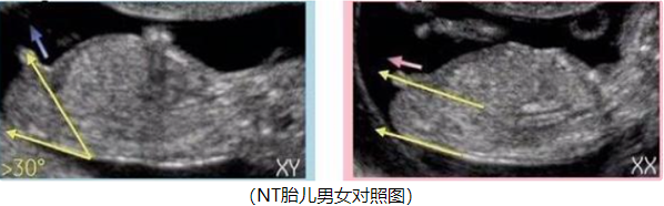 NT胎儿男女对照图