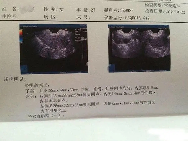 巧囊是子宫内膜异位症的一种病变