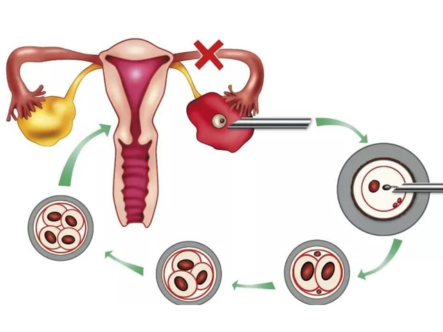 试管婴儿取卵详细流程图