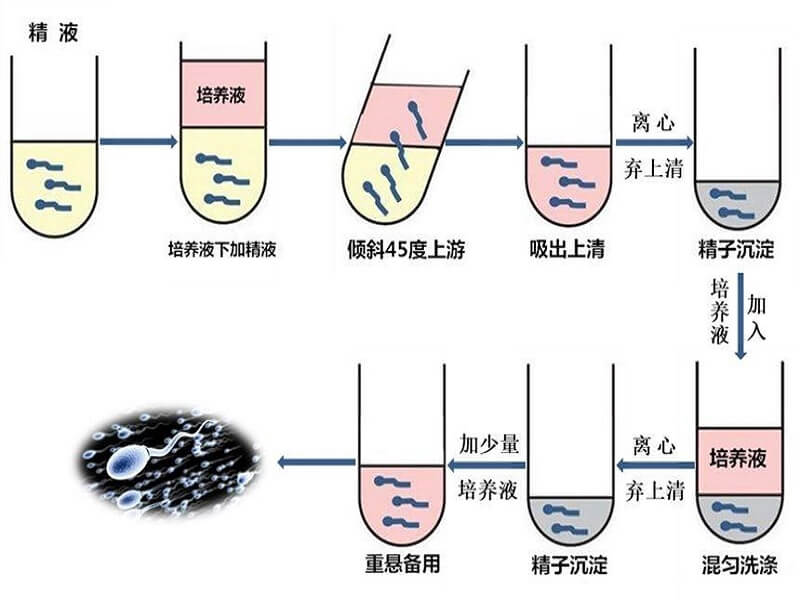 y精子分离术的价格